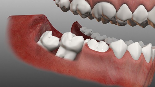 جراحی دندان عقل، مفید یا غیرمفید؟ 